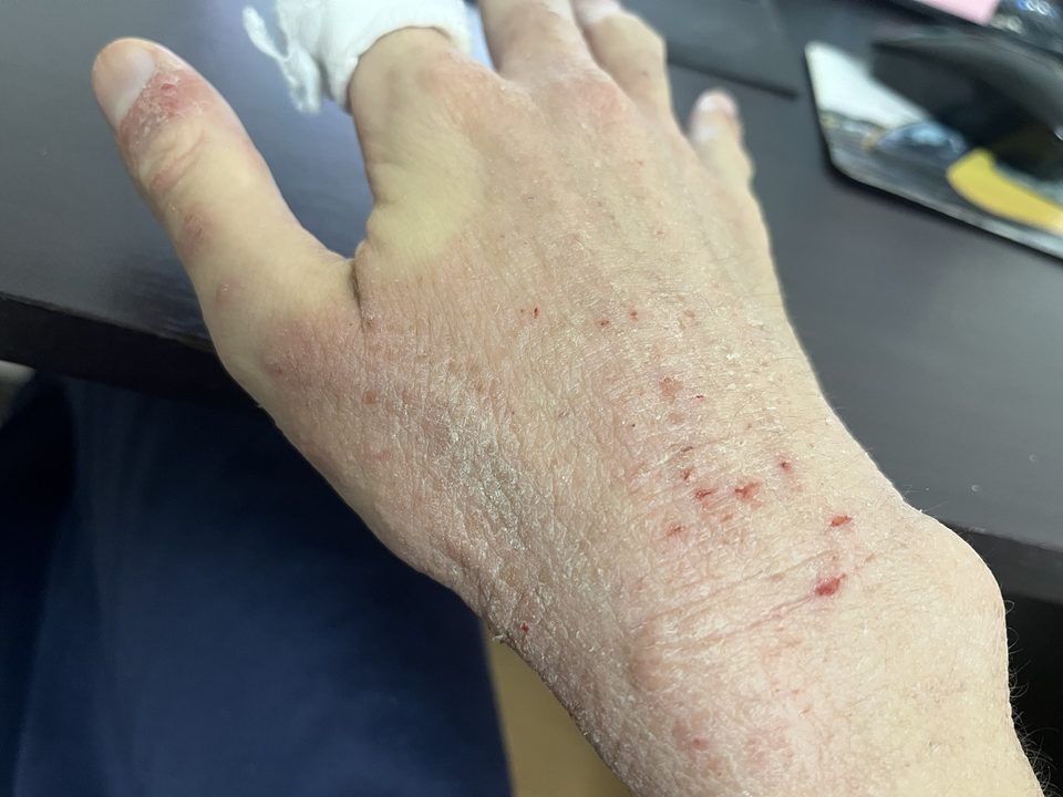 アトピーで悪化した右手の甲