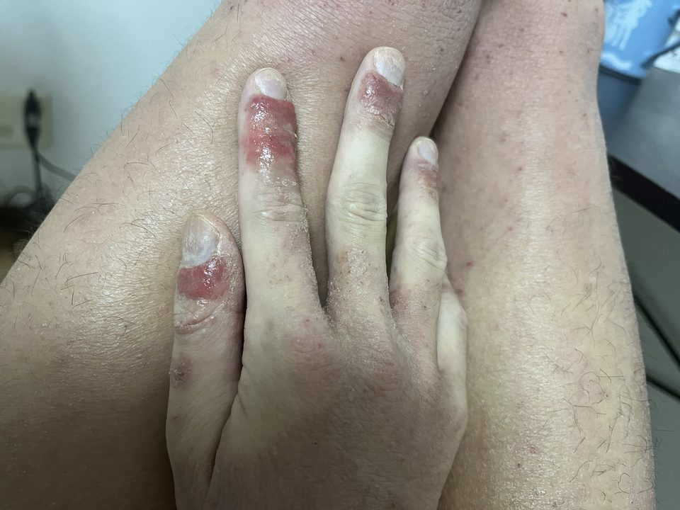 アトピーで悪化した右手指