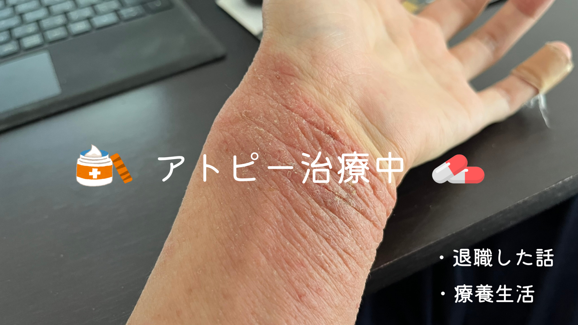 アトピーで悪化して左手首